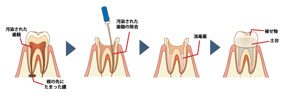 マイクロスコープによる、歯を守る精密根管治療|福岡市